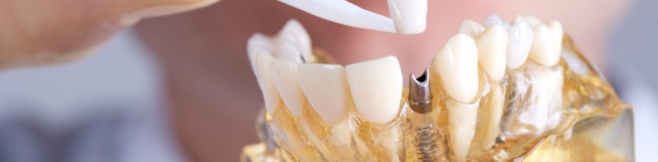 are dental implants worth it