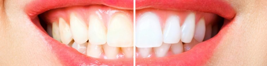 advantages of professional teeth whitening