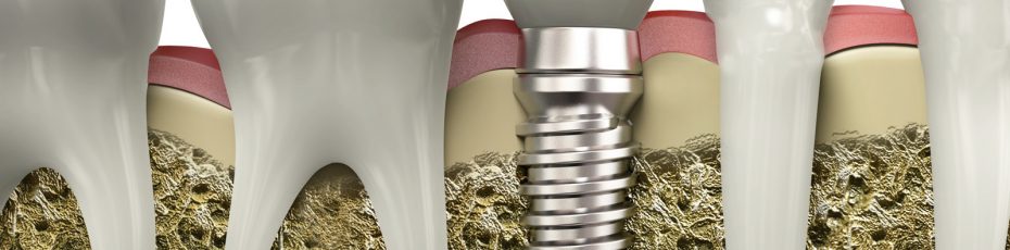 are dental implants the right option for you