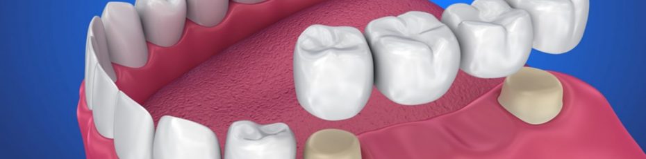 what are the pros and cons of getting a dental bridge