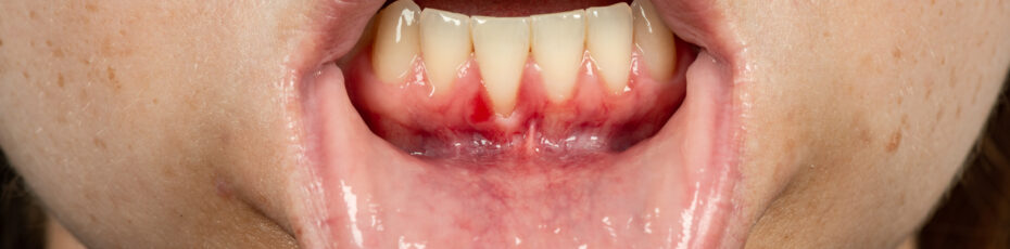 understanding gum disease early detection and prevention at checkups