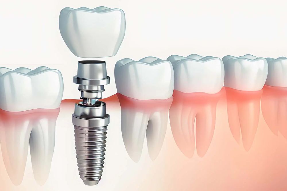 How-Painful-Is-Getting-A-Tooth-Implant